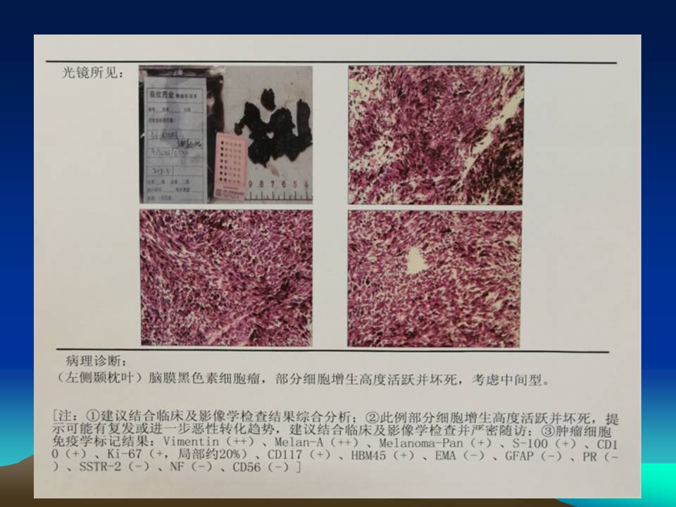 【疾病科普】颅内原发性黑色素瘤详解——唐都医院神经外科