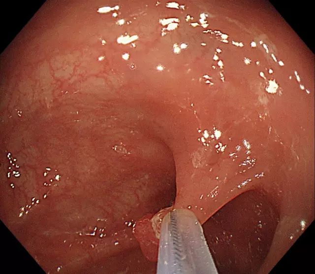 图解:肠镜下结肠息肉切除术