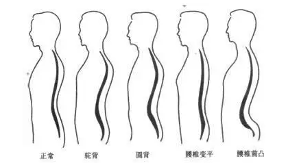 到底什么是延伸脊柱 小心脊柱变直哦