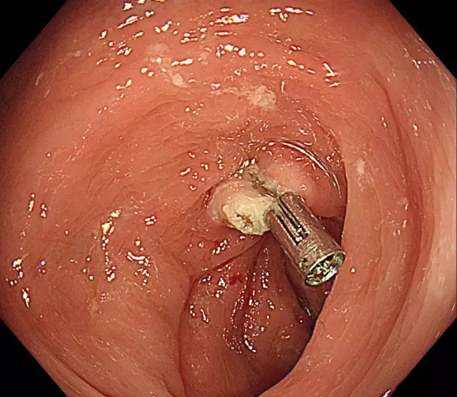 图解:肠镜下结肠息肉切除术