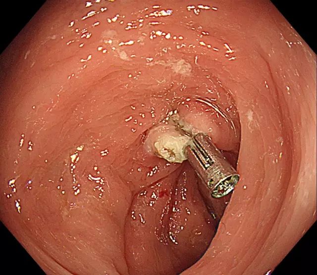 脱落的息肉需取出体外进行病理切片检查,而留置于肠道内的金属夹也将
