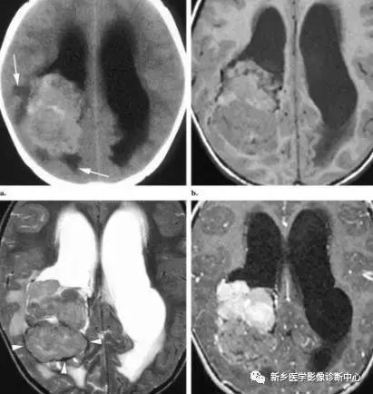 侧脑室三角区肿瘤的诊断