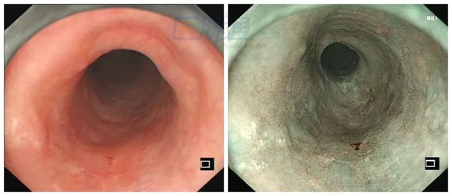 食管病变图谱白光与nbi