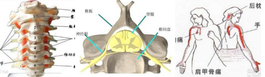 颈椎病又称颈椎综合征