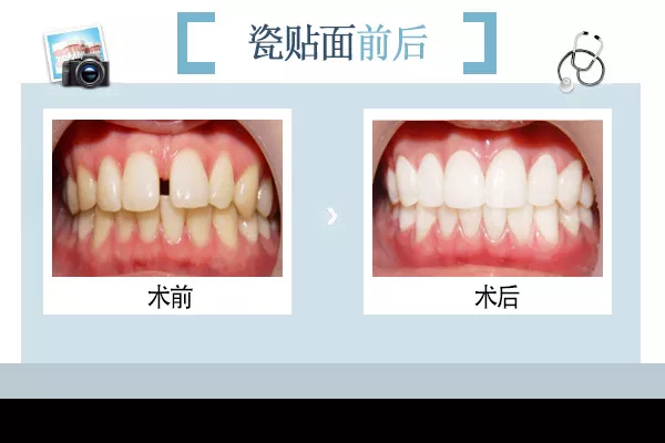 小哥哥小姐姐牙齿贴面了解一下