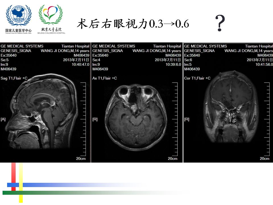 儿童视路胶质瘤手术 如何通过视觉纤维重建来保留患者视力 - 葛明