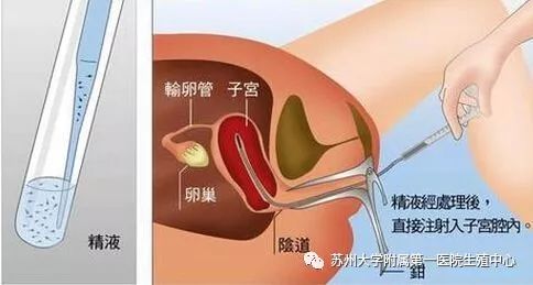 宫腔内人工授精  人工授精是通过非性交,人工的方式,将优化处理后的