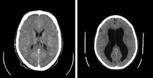 两幅脑部断层扫描图像,左图是正常人,右图则是一个脑积水患者,注意脑