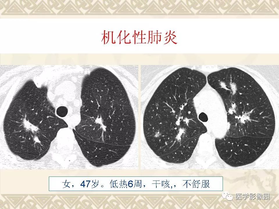 片状高密度影部分)肺部弥漫性病变的hrct诊断