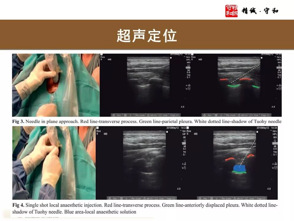 椎旁神经阻滞怎么做看这里