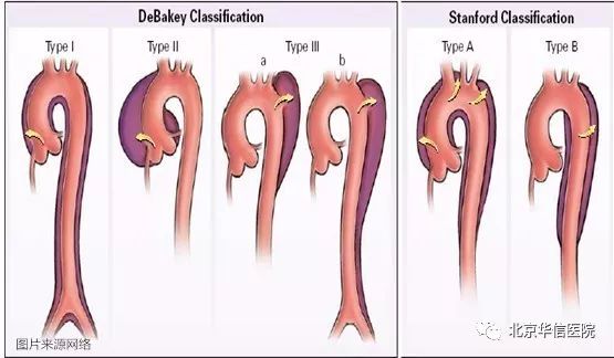 生机无限记北京华信医院综合icu成功救治主动脉夹层合并脑梗塞患者