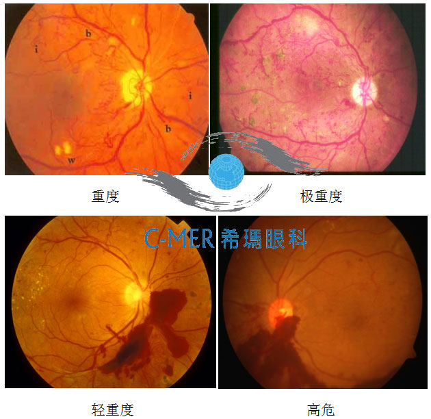 对眼睛来说,糖尿病与白内障,青光眼,感染性眼疾,视神经病变,黄斑水肿