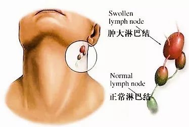 若颈部,腋窝或腹股沟淋巴结肿大长时间不消,坚硬,固定,表面不平