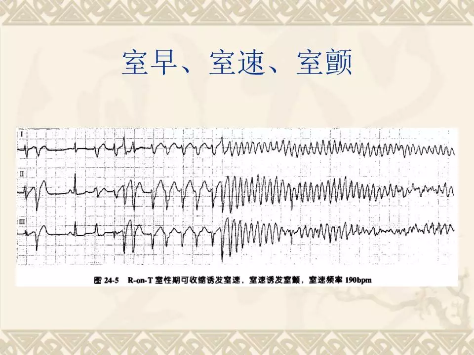 诱因 诱发室颤的原因有很多,包括室性早搏,室性心动过速等