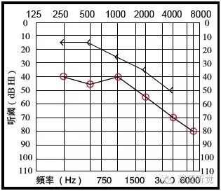 混合性听力损失:气导与骨导之间差异大于10db且骨导在正常范围之外的