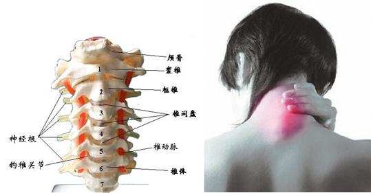 颈椎病高清图