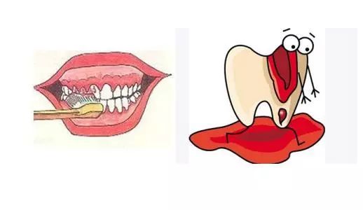牙龈出血您千万别觉得是小事,延误治疗可影响全身健康