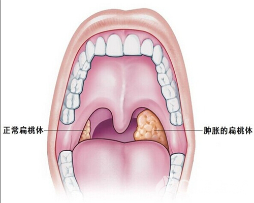 这才是小儿扁桃体肿大治疗的正确打开方式