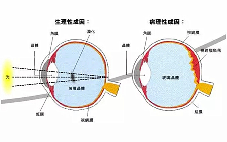 武汉飞蚊症激光后要注意什么,艾格眼科专家说千万不要