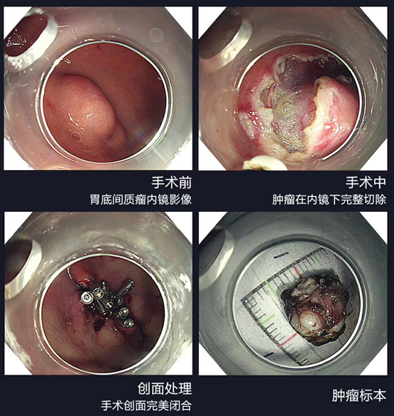 庄剑波教授介绍,内镜黏膜下剥离术(esd)很难,是内镜最高级别的4级手术