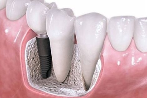选择精准即刻用种植牙技术的四大理由还原真牙咀嚼力