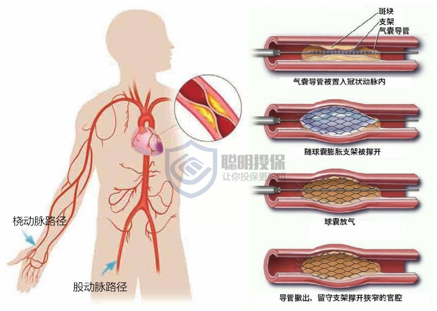 保险条款解读急性心肌梗塞与冠状动脉介入术