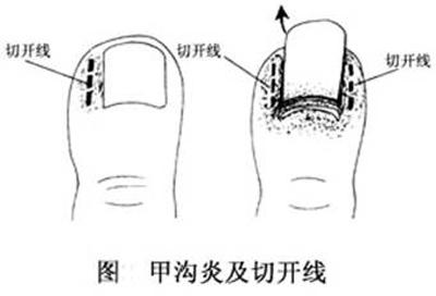 脚指甲出浓怎么办