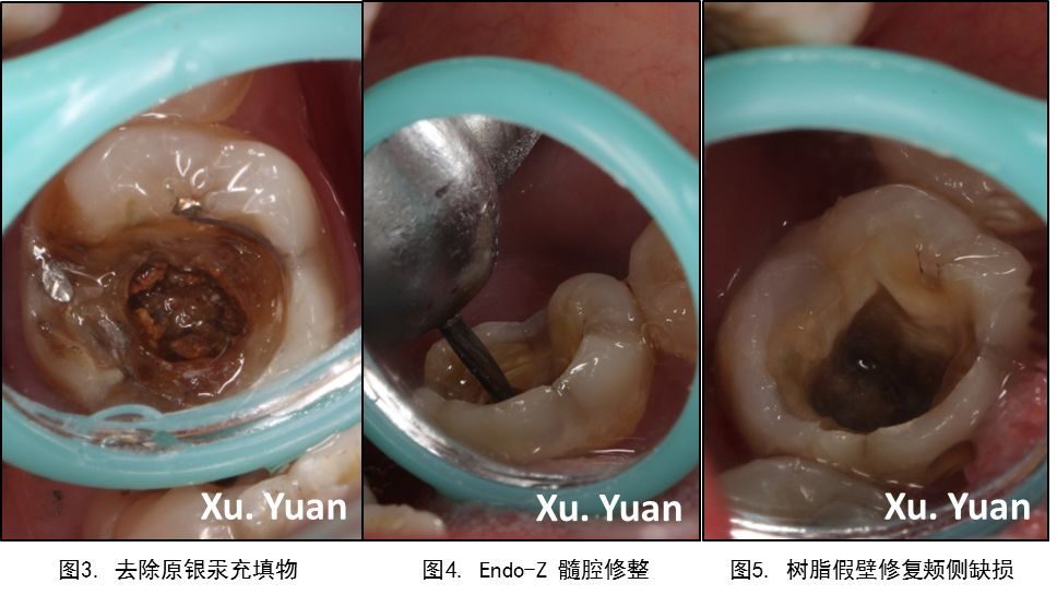 病例十五 | 显微根管治疗与高嵌体修复右下第一磨牙慢性根尖周炎的