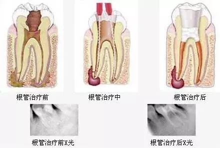 牙龈长肉芽怎么办