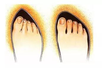 过尖的鞋头很容易将大拇指往内压,大拇指关节处经时间积累内凹,形成