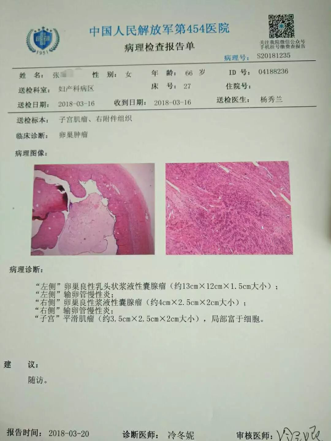 5cm),子宫后壁见一直径约3cm肌瘤,术中快速病理提示:右侧卵巢良性病变