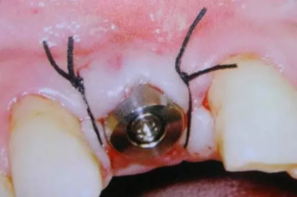 史上最全的种植牙全过程介绍,不得不看!