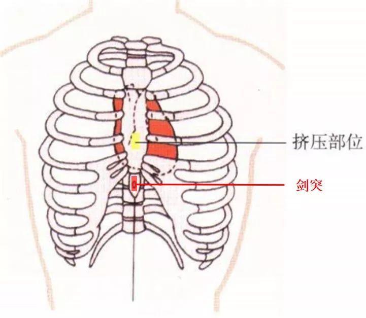 要注意的是,实施胸外按压时,施加压力的位置应该在剑突上的胸骨体,而