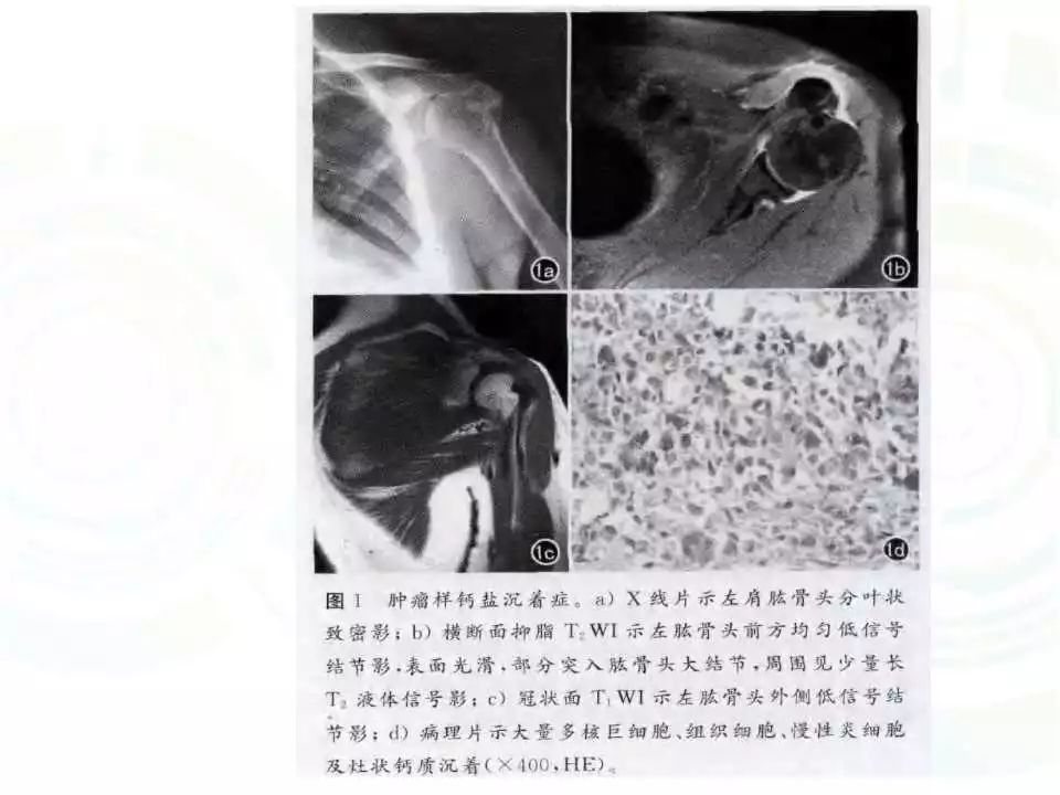 【每日一例| 580例】肿瘤样钙质沉着症