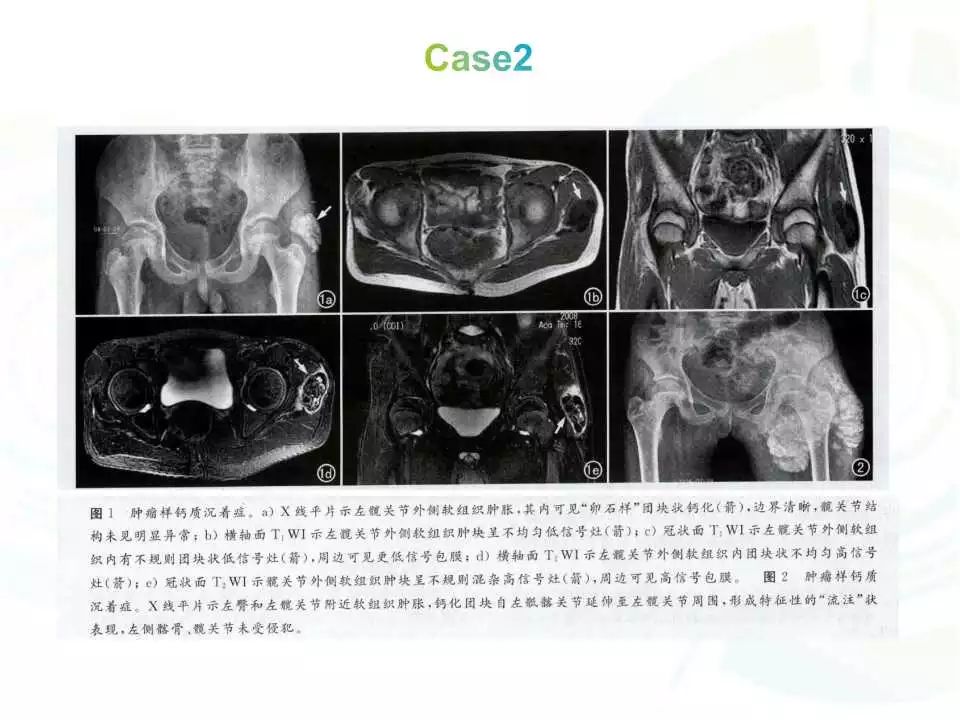 【每日一例| 580例】肿瘤样钙质沉着症