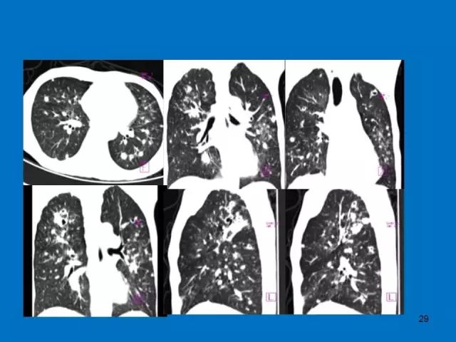 肺部炎症的影像学汇总