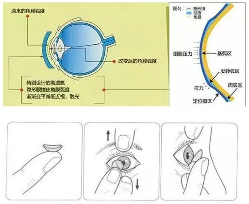 【健康科普】角膜塑形镜,解决孩子视力问题的贴身保姆!