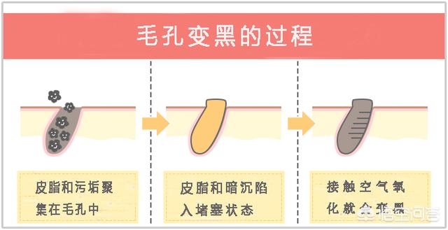 鼻子毛孔粗有黑头怎么办