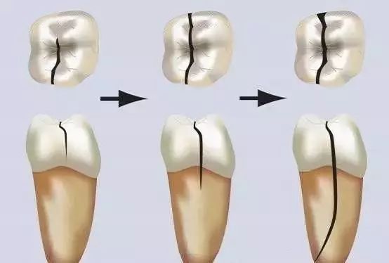 牙齿出现细微裂纹?对不起我是牙隐裂