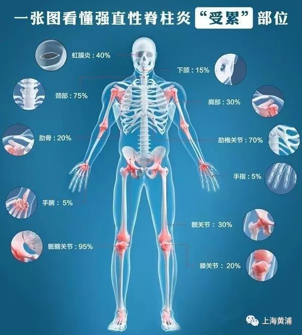 当心是"强直性脊柱炎"!