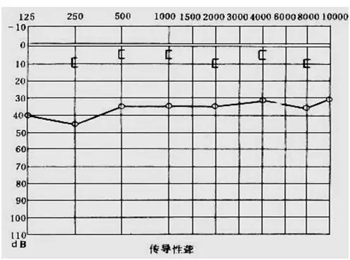 正常听力表现在听力图上,气导和骨导曲线均应在25db以内.  3.