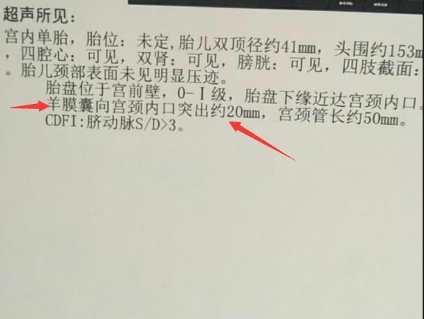 妹妹接妇产科医生电话,让去省妇幼,说其胎儿过低,羊膜囊已入宫颈