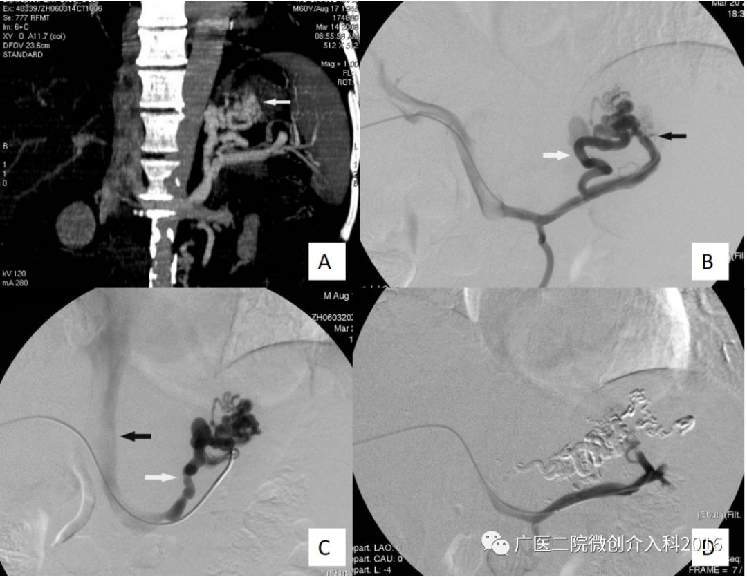 健康 正文  男,53岁,因"呕血600ml"入院,诊断为肝硬化胃底静脉曲张