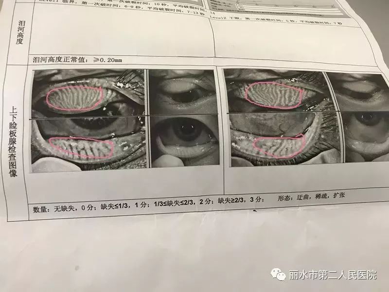 描红处表示睑板腺功能障碍