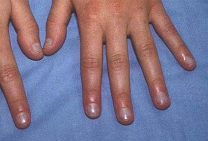 母婴 正文  1:手指倒刺区域皮肤软组织感染 有些宝宝自己可能自己都没