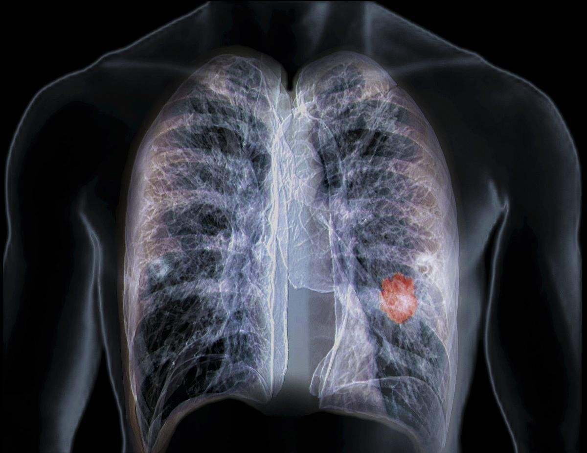 早期肺癌低剂量CT筛查 是预防肺癌的最有效措施_社会热点_社会频道_云南网