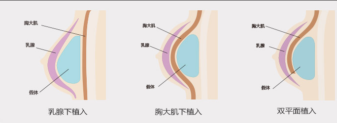 3, 假体一般植入乳房的哪个部位?