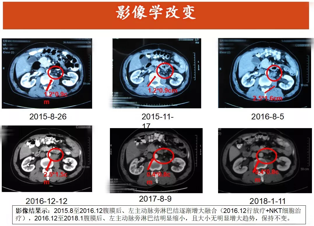 【结肠癌腹膜淋巴结转移,nkt治疗案例展示】清华nkt·乐和亲友·2015