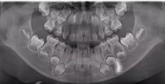 恒牙牙胚埋藏在乳牙根下,尚未发育完全