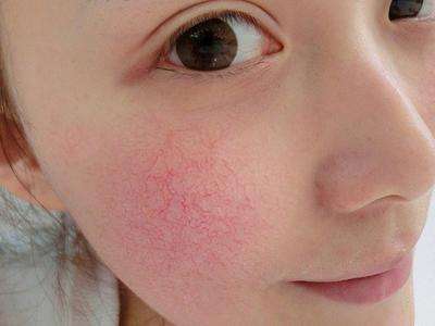 使得皮肤损伤,留下细小划痕,且容易出现红血丝